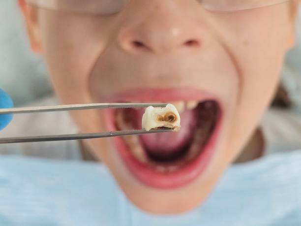 Best Emergency Wisdom Teeth Removal in Brushy Creek, TX