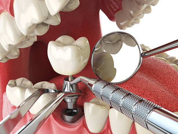 Best Emergency Tooth Extraction in Brushy Creek, TX